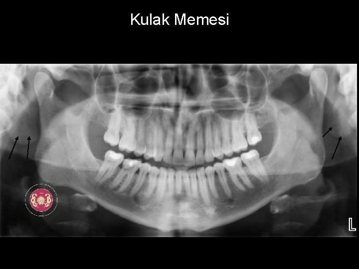 Kulak Memesi 