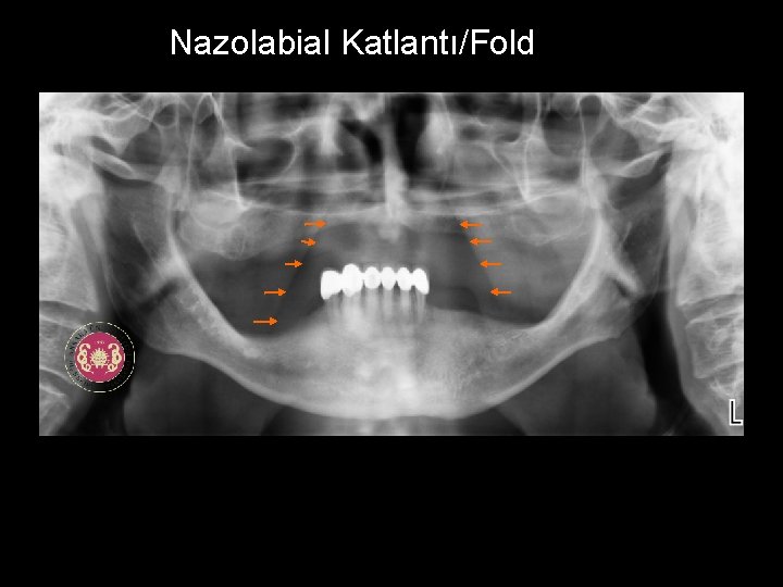 Nazolabial Katlantı/Fold 