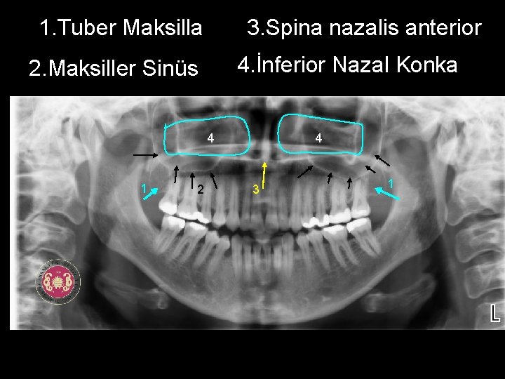 3. Spina nazalis anterior 1. Tuber Maksilla 4. İnferior Nazal Konka 2. Maksiller Sinüs