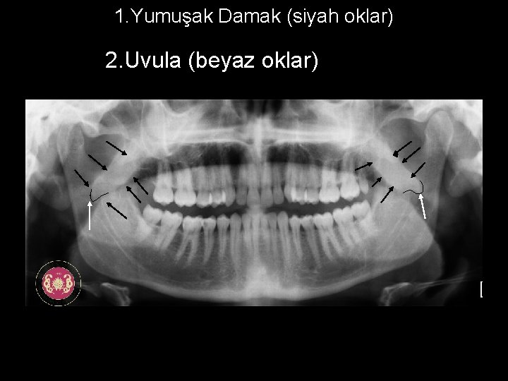 1. Yumuşak Damak (siyah oklar) 2. Uvula (beyaz oklar) 