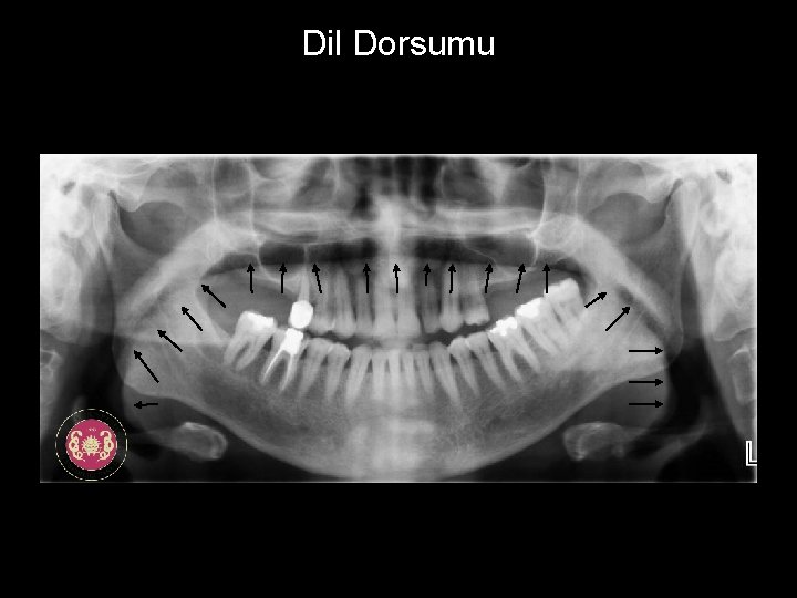Dil Dorsumu 