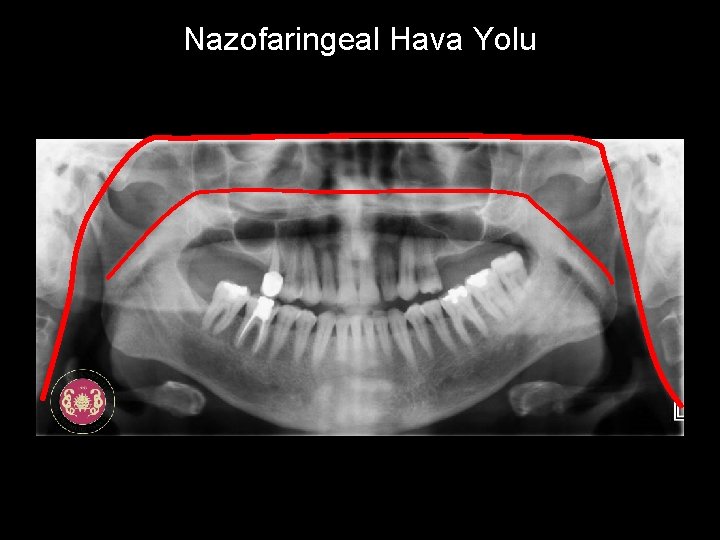 Nazofaringeal Hava Yolu 