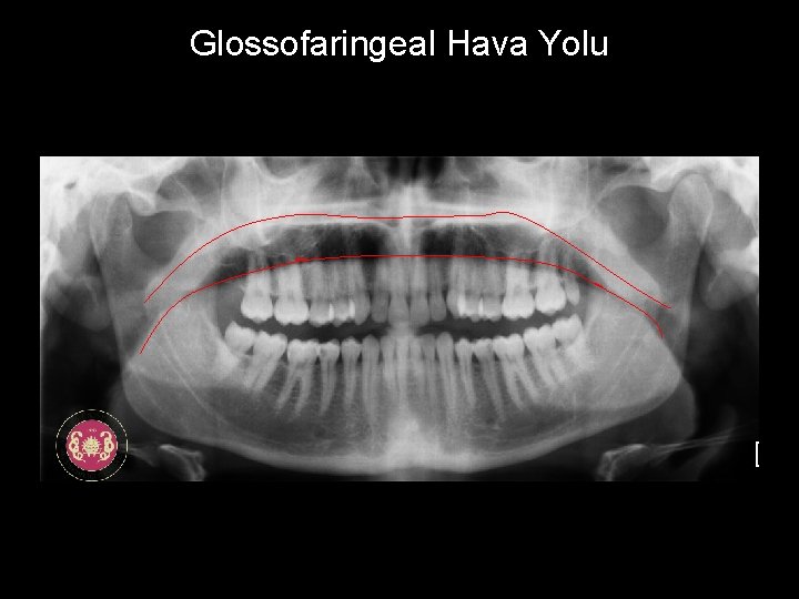Glossofaringeal Hava Yolu 
