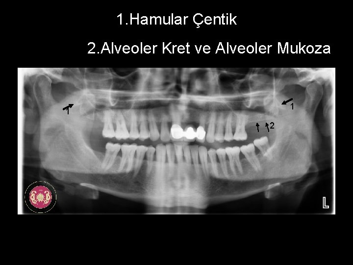 1. Hamular Çentik 2. Alveoler Kret ve Alveoler Mukoza 1 1 2 