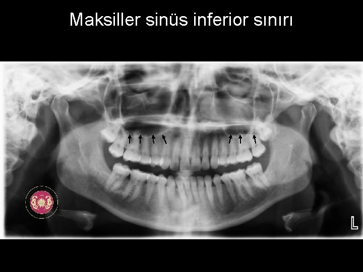 Maksiller sinüs inferior sınırı 