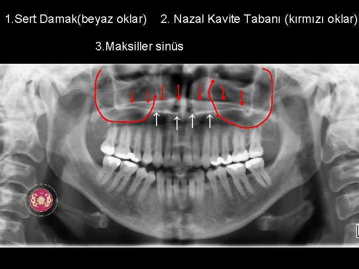 1. Sert Damak(beyaz oklar) 2. Nazal Kavite Tabanı (kırmızı oklar) 3. Maksiller sinüs ↓