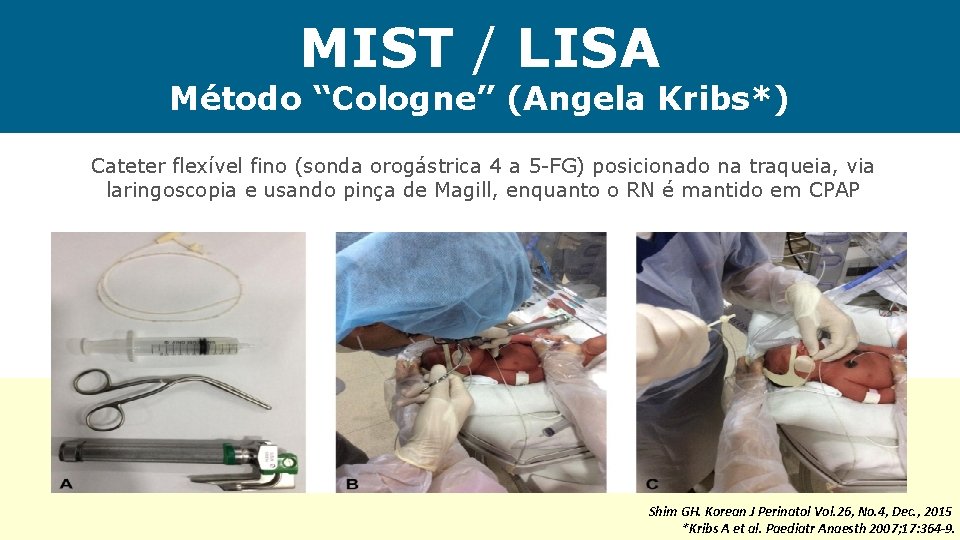 MIST / LISA Método “Cologne” (Angela Kribs*) Cateter flexível fino (sonda orogástrica 4 a