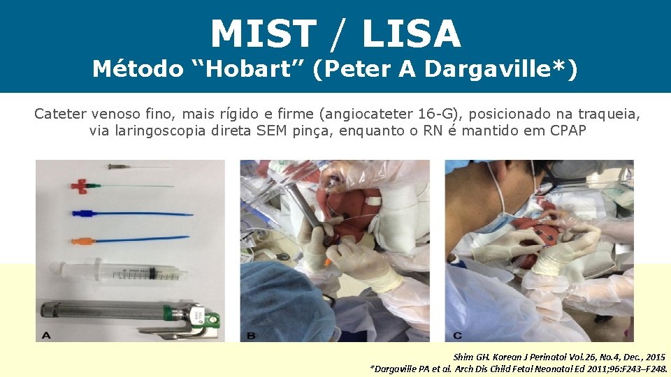 MIST / LISA Método “Hobart” (Peter A Dargaville*) Cateter venoso fino, mais rígido e