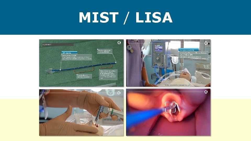MIST / LISA 
