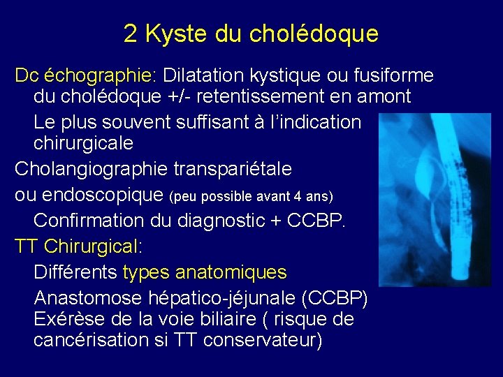 2 Kyste du cholédoque Dc échographie: Dilatation kystique ou fusiforme du cholédoque +/- retentissement