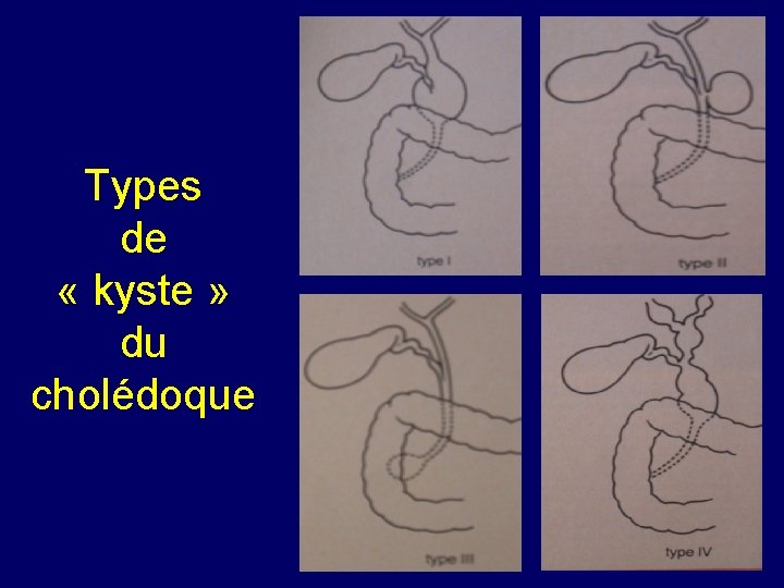 Types de « kyste » du cholédoque 