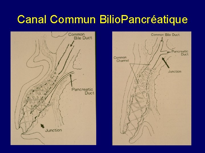 Canal Commun Bilio. Pancréatique 