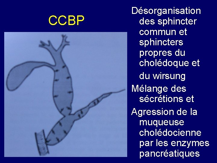 CCBP Désorganisation des sphincter commun et sphincters propres du cholédoque et du wirsung Mélange