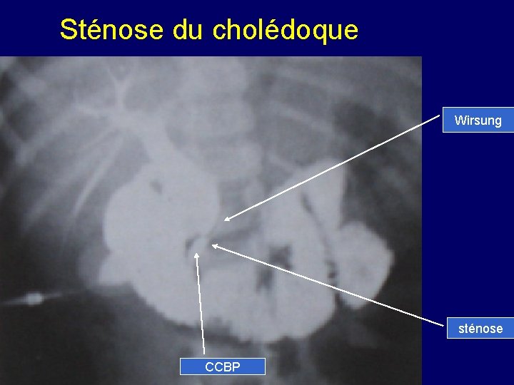 Sténose du cholédoque Wirsung sténose CCBP 