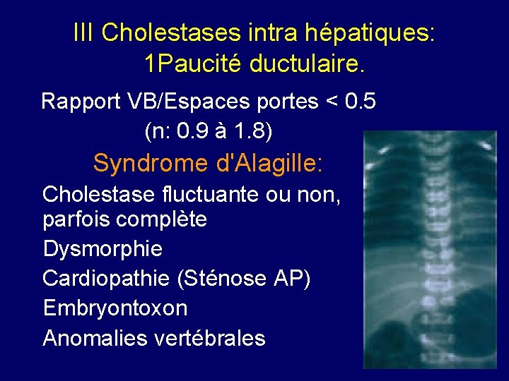 III Cholestases intra hépatiques: 1 Paucité ductulaire. Rapport VB/Espaces portes < 0. 5 (n: