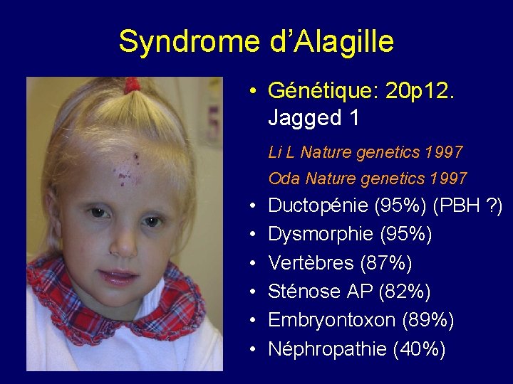 Syndrome d’Alagille • Génétique: 20 p 12. Jagged 1 Li L Nature genetics 1997