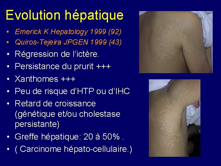 Evolution hépatique • Emerick K Hepatology 1999 (92) • Quiros-Tejeira JPGEN 1999 (43) •