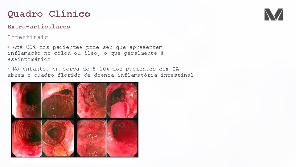 Quadro Clínico Extra-articulares Intestinais • Até 60% dos pacientes pode ser que apresentem inflamação