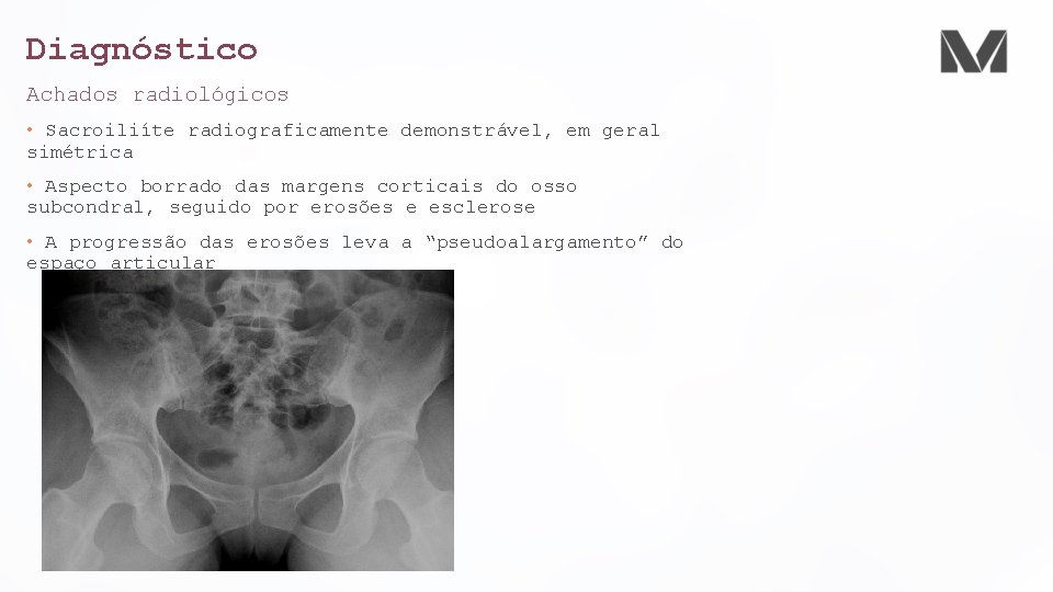Diagnóstico Achados radiológicos • Sacroiliíte radiograficamente demonstrável, em geral simétrica • Aspecto borrado das