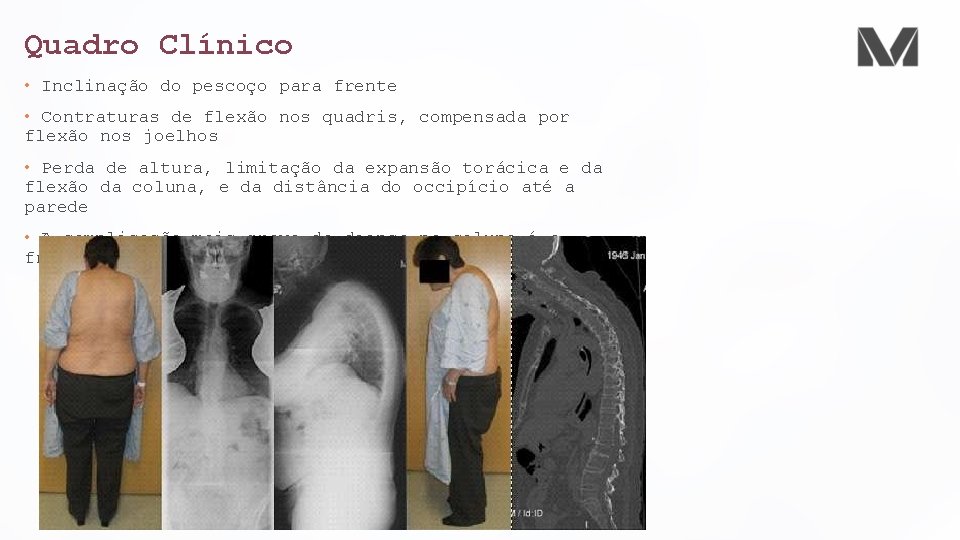 Quadro Clínico • Inclinação do pescoço para frente • Contraturas de flexão nos quadris,