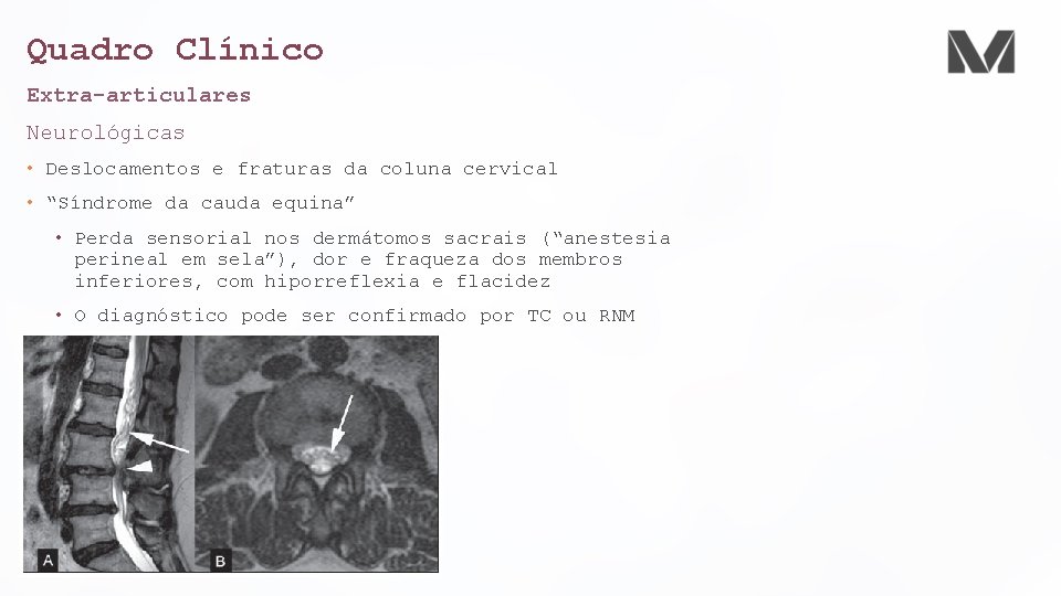 Quadro Clínico Extra-articulares Neurológicas • Deslocamentos e fraturas da coluna cervical • “Síndrome da