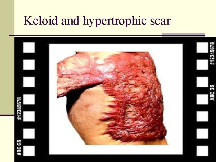 Keloid and hypertrophic scar 