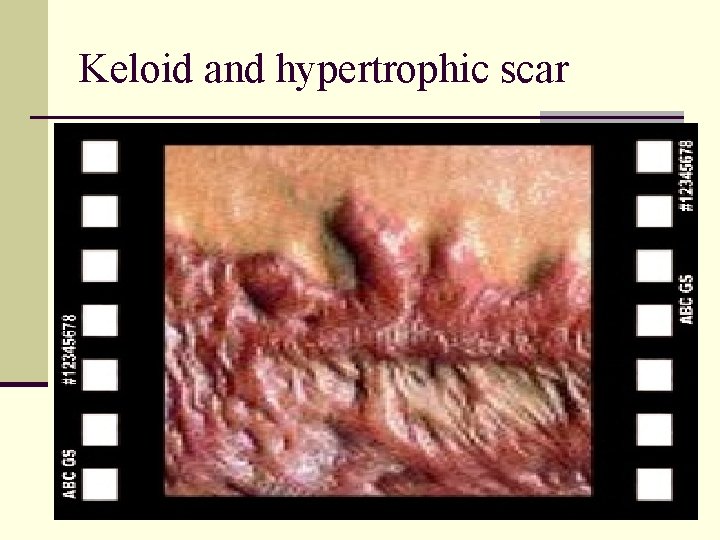 Keloid and hypertrophic scar 