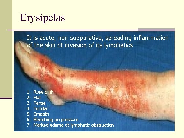 Erysipelas It is acute, non suppurative, spreading inflammation of the skin dt invasion of