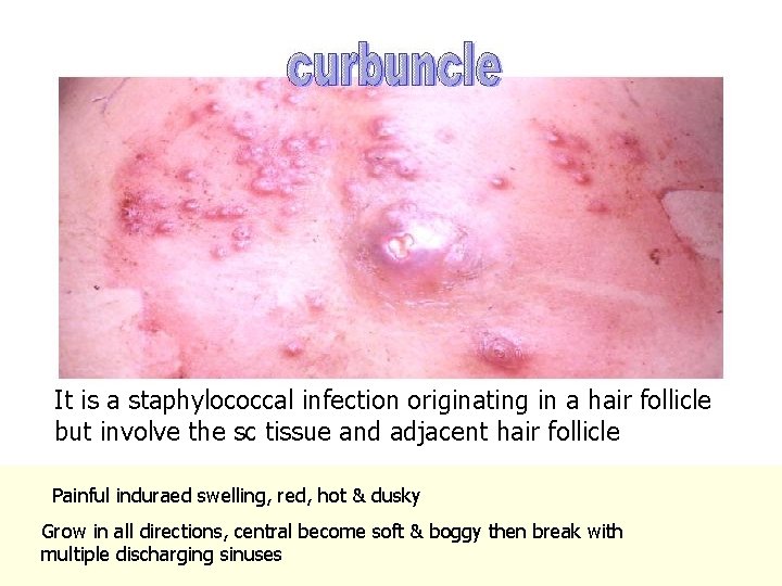 It is a staphylococcal infection originating in a hair follicle but involve the sc