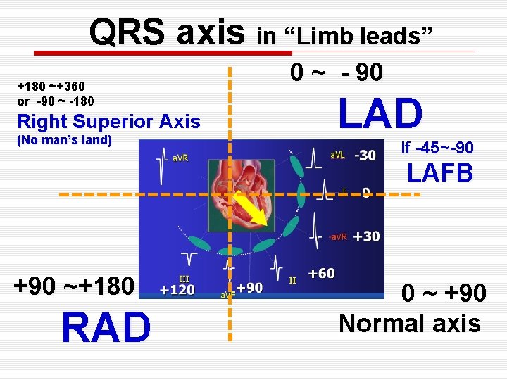 QRS axis in “Limb leads” +180 ~+360 or -90 ~ -180 Right Superior Axis