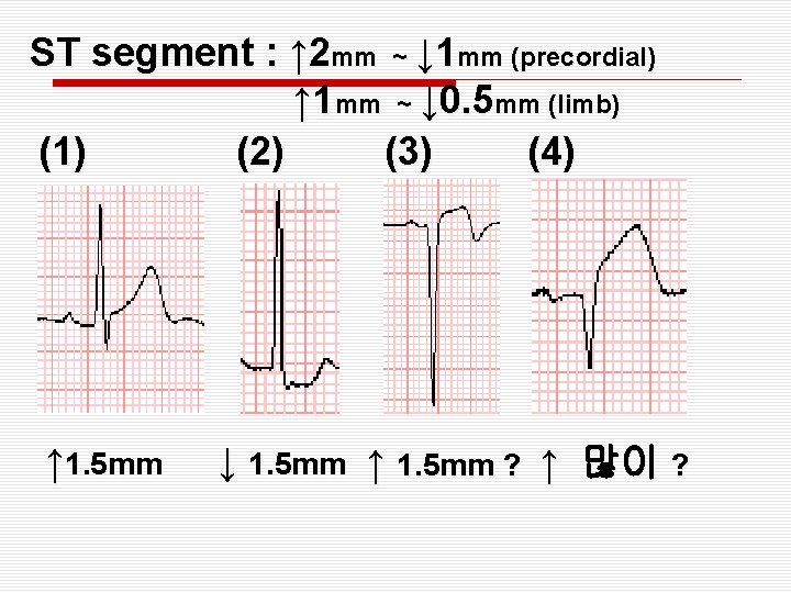 ST segment : ↑ 2 mm ~ ↓ 1 mm (precordial) ↑ 1 mm
