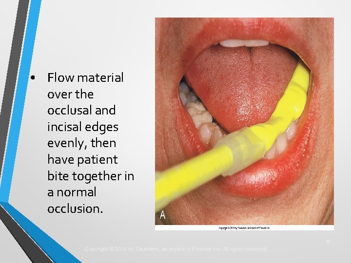 • Flow material over the occlusal and incisal edges evenly, then have patient • Flow material over the occlusal and incisal edges evenly, then have patient