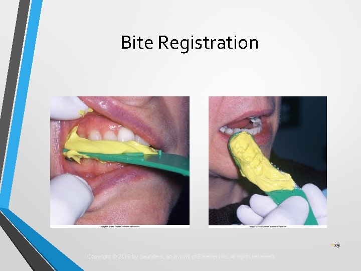 Bite Registration • 29 Copyright © 2016 by Saunders, an imprint of Elsevier Inc. Bite Registration • 29 Copyright © 2016 by Saunders, an imprint of Elsevier Inc.