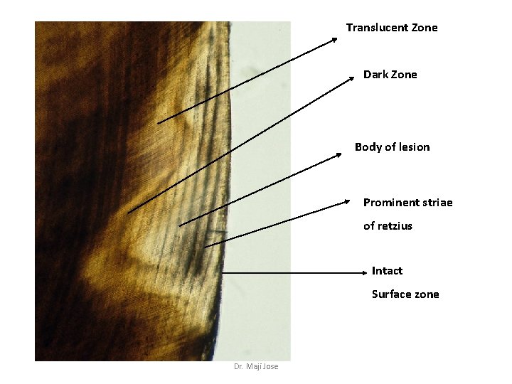 Translucent Zone Dark Zone Body of lesion Prominent striae of retzius Intact Surface zone