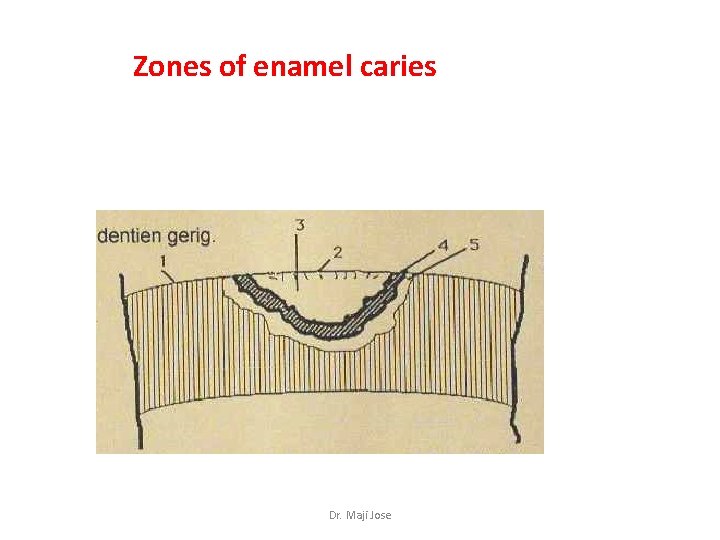 Zones of enamel caries Dr. Maji Jose 