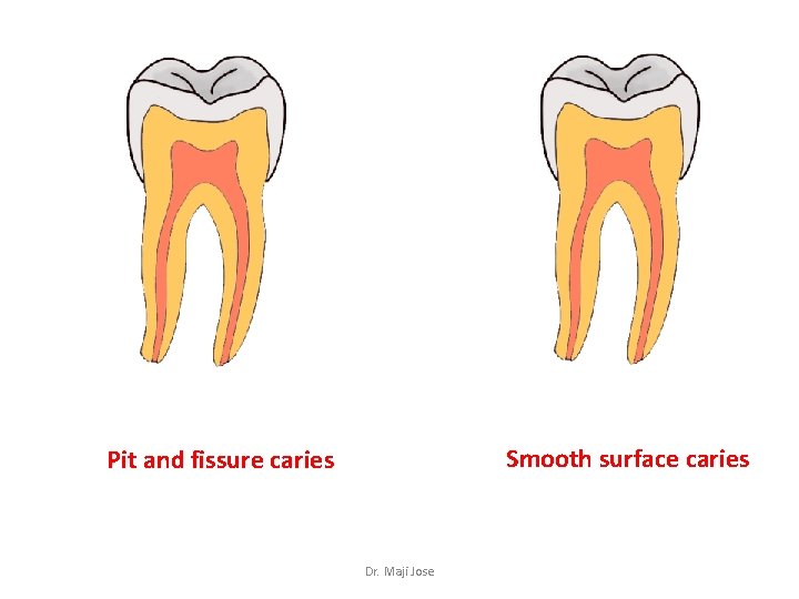 Smooth surface caries Pit and fissure caries Dr. Maji Jose 