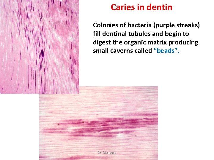 Caries in dentin Colonies of bacteria (purple streaks) fill dentinal tubules and begin to