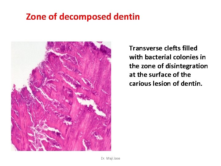 Zone of decomposed dentin Transverse clefts filled with bacterial colonies in the zone of