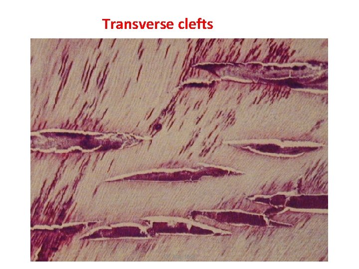 Transverse clefts Dr. Maji Jose 