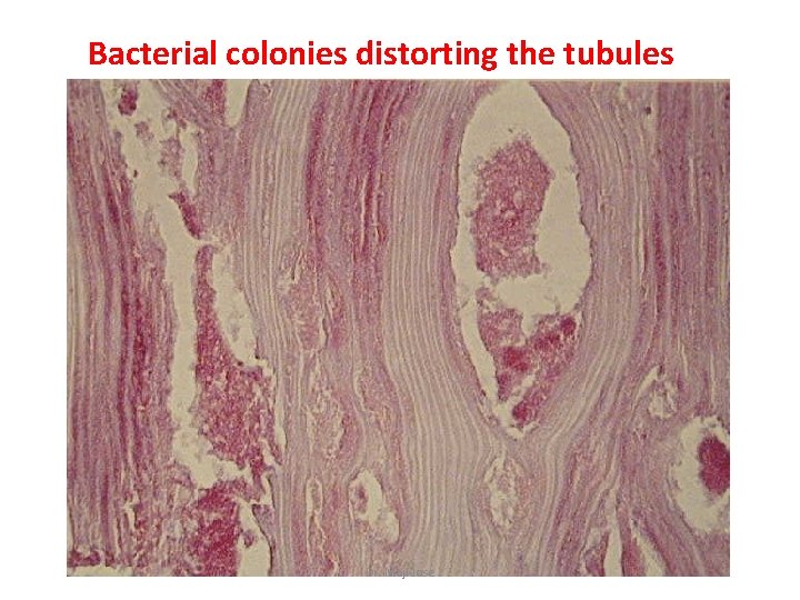 Bacterial colonies distorting the tubules Dr. Maji Jose 