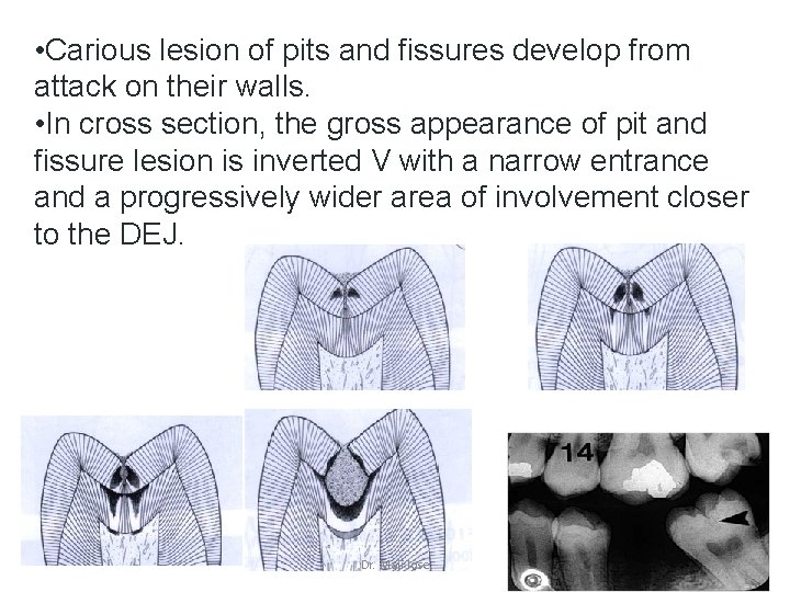  • Carious lesion of pits and fissures develop from attack on their walls.