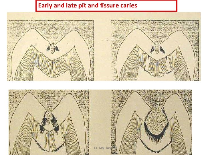 Early and late pit and fissure caries Dr. Maji Jose 