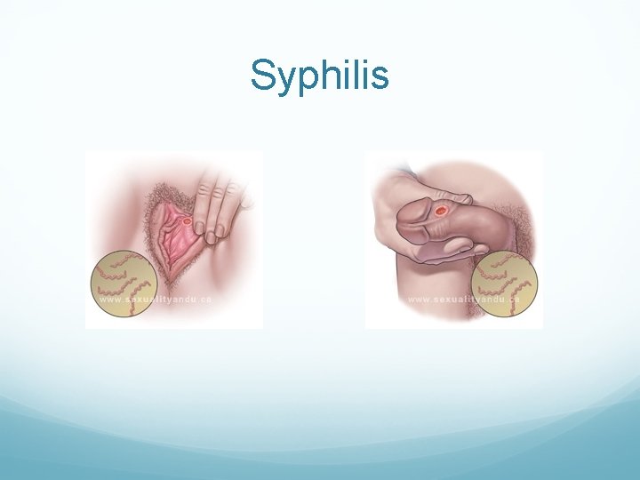 Syphilis Syphilis