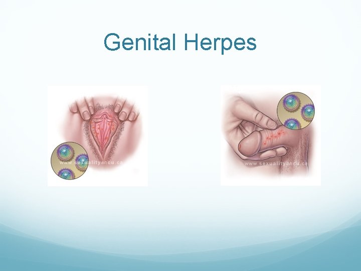 Genital Herpes Genital Herpes