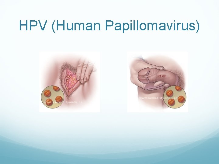 HPV (Human Papillomavirus) HPV (Human Papillomavirus)