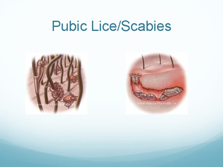 Pubic Lice/Scabies Pubic Lice/Scabies
