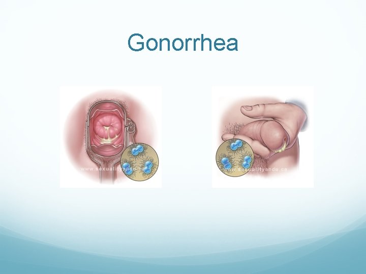 Gonorrhea Gonorrhea