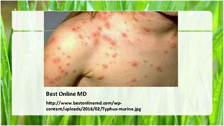 Best Online MD http: //www. bestonlinemd. com/wpcontent/uploads/2016/02/Typhus-murine. jpg 