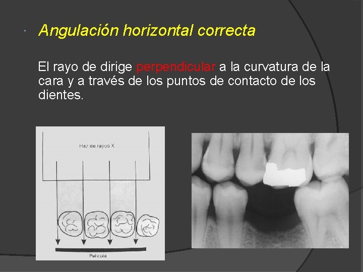  Angulación horizontal correcta El rayo de dirige perpendicular a la curvatura de la