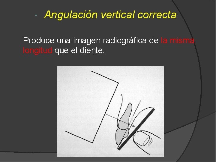  Angulación vertical correcta Produce una imagen radiográfica de la misma longitud que el